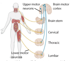 The Lancet, Figure 1 A: a schematic showing UMNs (blue), which relay signals from the motor cortex to the LMNs (yellow), which relay signals to the muscles.